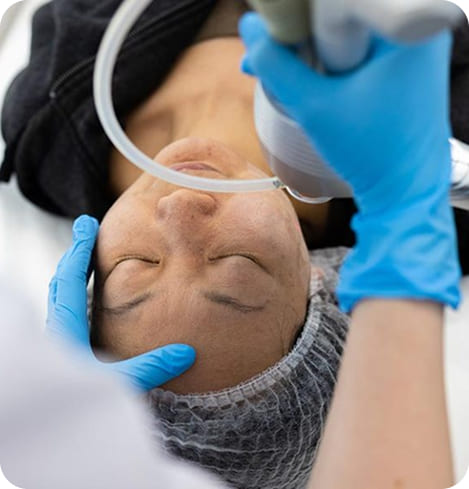 Smartskin CO2 Laser Resurfacing