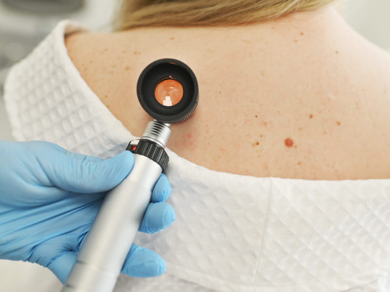 Actinic Keratosis (Pre-cancerous Growths)