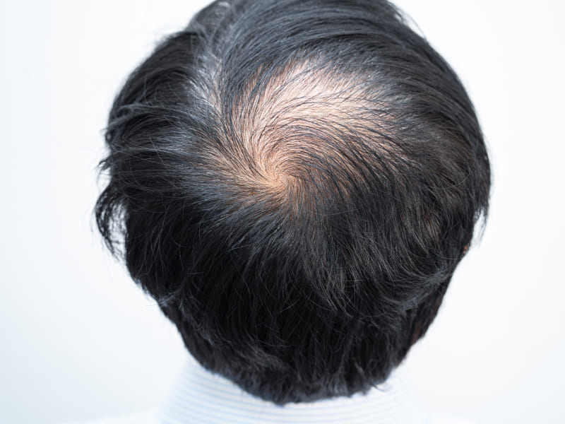 Propecia for Male-Pattern Baldness