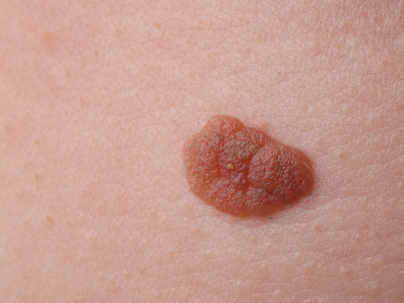 Seborrheic Keratosis