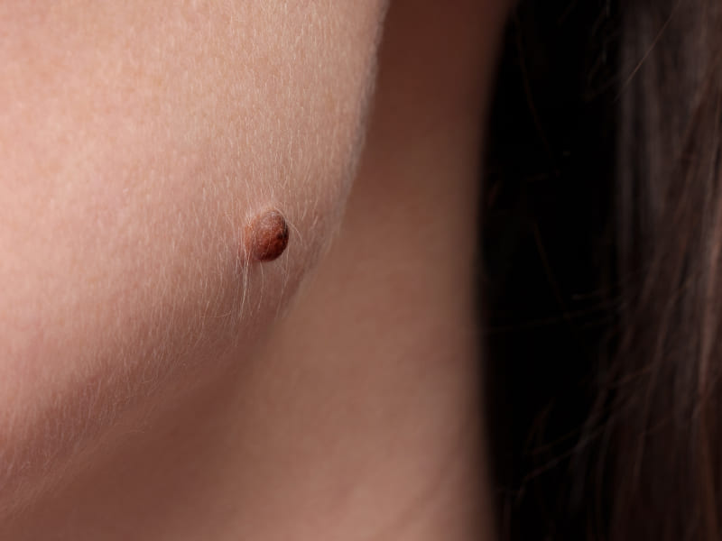 Skin Tags